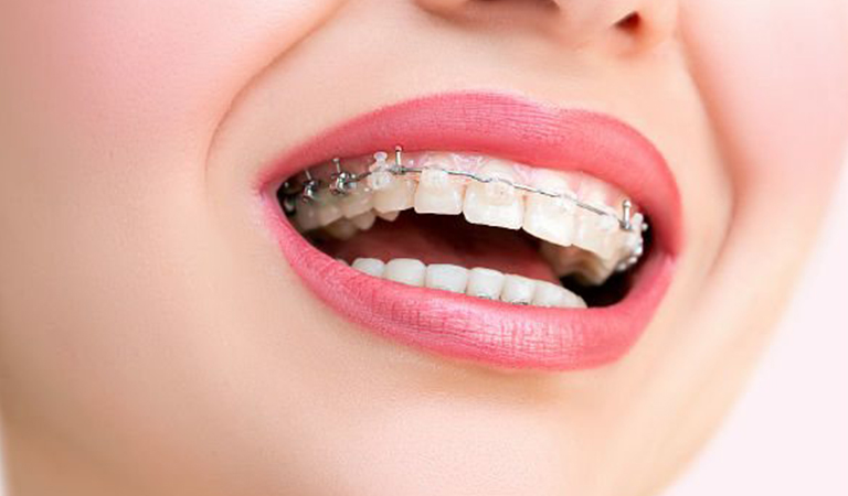 The Advantages Of Clear Braces 2 Blog 108