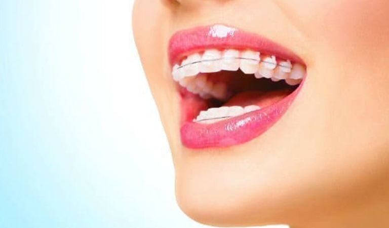 Benefits Of Friction-Free Ligatureless Braces 2 Blog 22