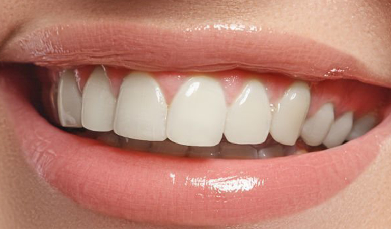 Common Causes Of Overbites And Underbites 3 Blog 23