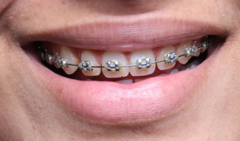 Functional Benefits Of Traditional Braces 5 Blog 25