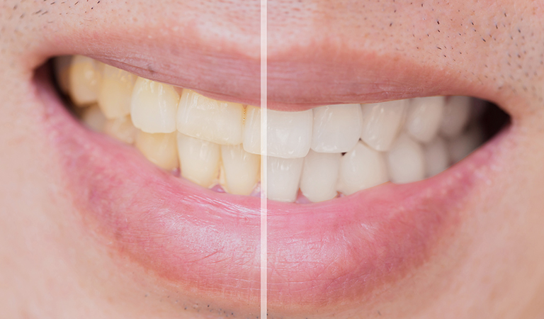Common Causes Of Stained Teeth 7 Blog 27