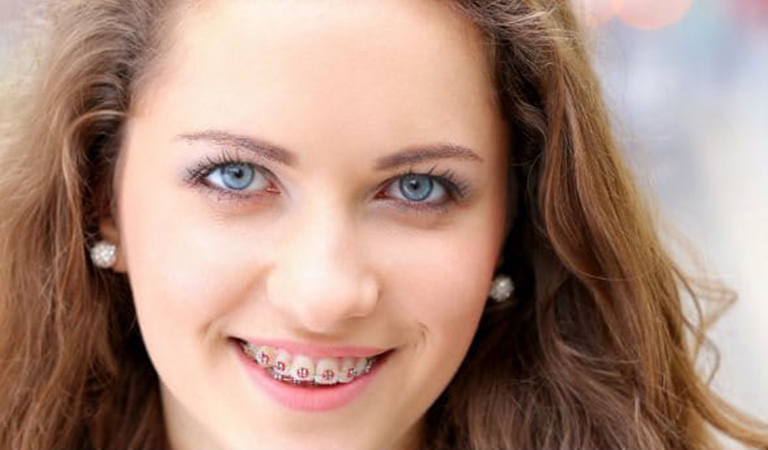 Braces For Teens 2 Blog 32