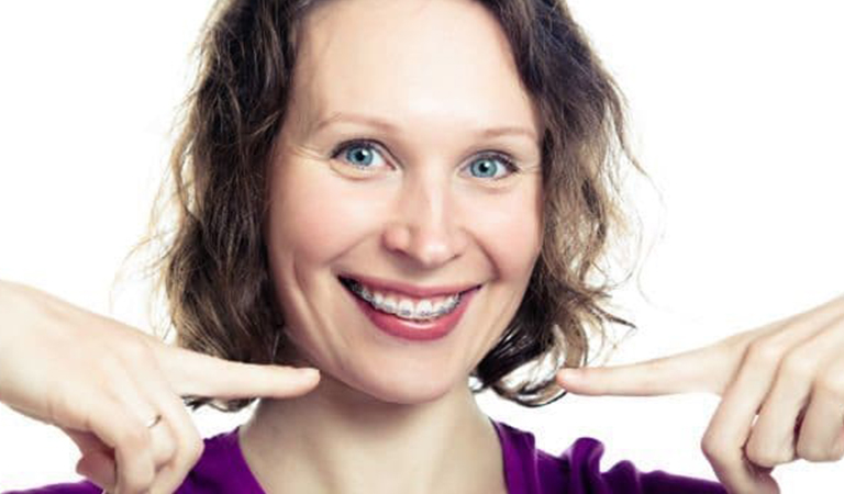 Different Types Of Braces 3 Blog 33