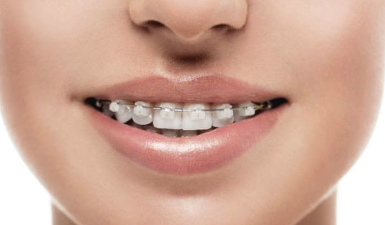 Why Get Clear Braces? 8 Blog 75