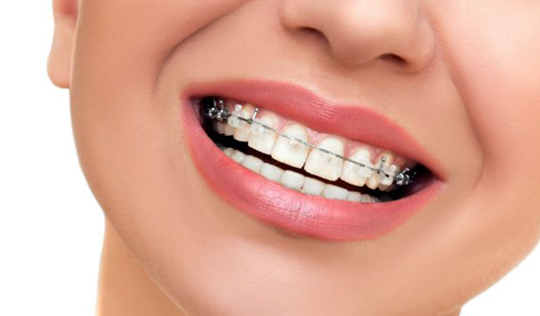 Clear Braces For A Discreet Option 6 Blog 83