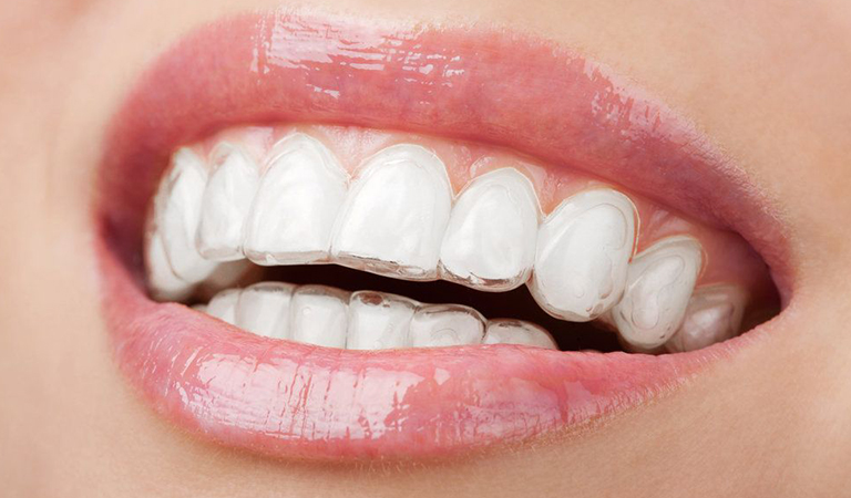 Invisalign Treatment In Oviedo: What Are The Benefits? 6 Blog 93