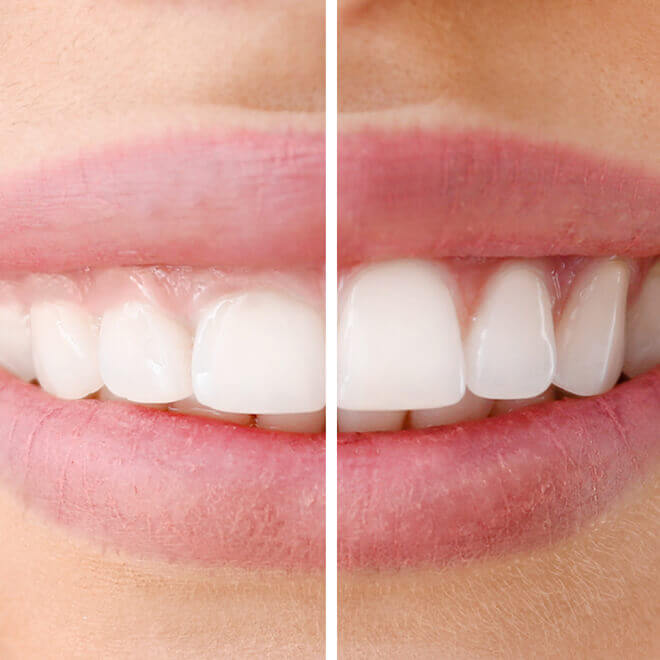 Laser gingival recontouring
