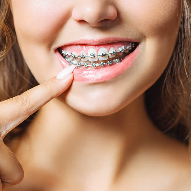 Self-tightening braces