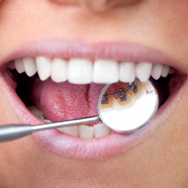 Behind the teeth inbraces