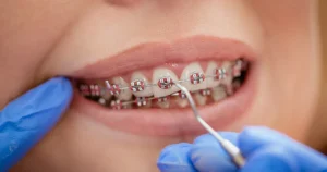 Braces Orlando Treatments